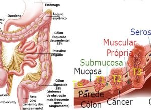 cancer-colorretal-avanca-entre-jovens-e-ja-atinge-1-em-cada-5-pacientes-antes-dos-55-anos